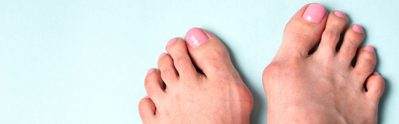 How to treat a bunion?