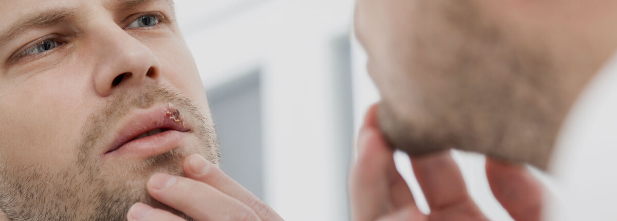How to get rid of cold sores in the early stages?
