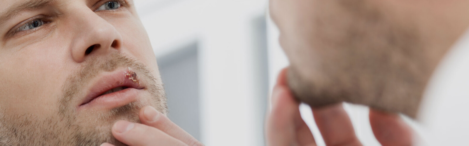 How to get rid of cold sores in the early stages?