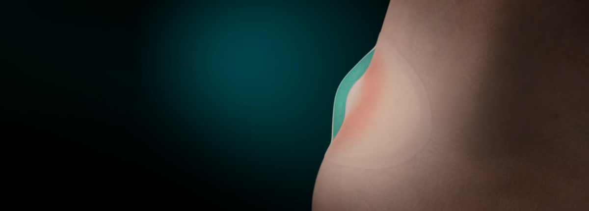 Hydrocolloid Plaster: Mode of Action