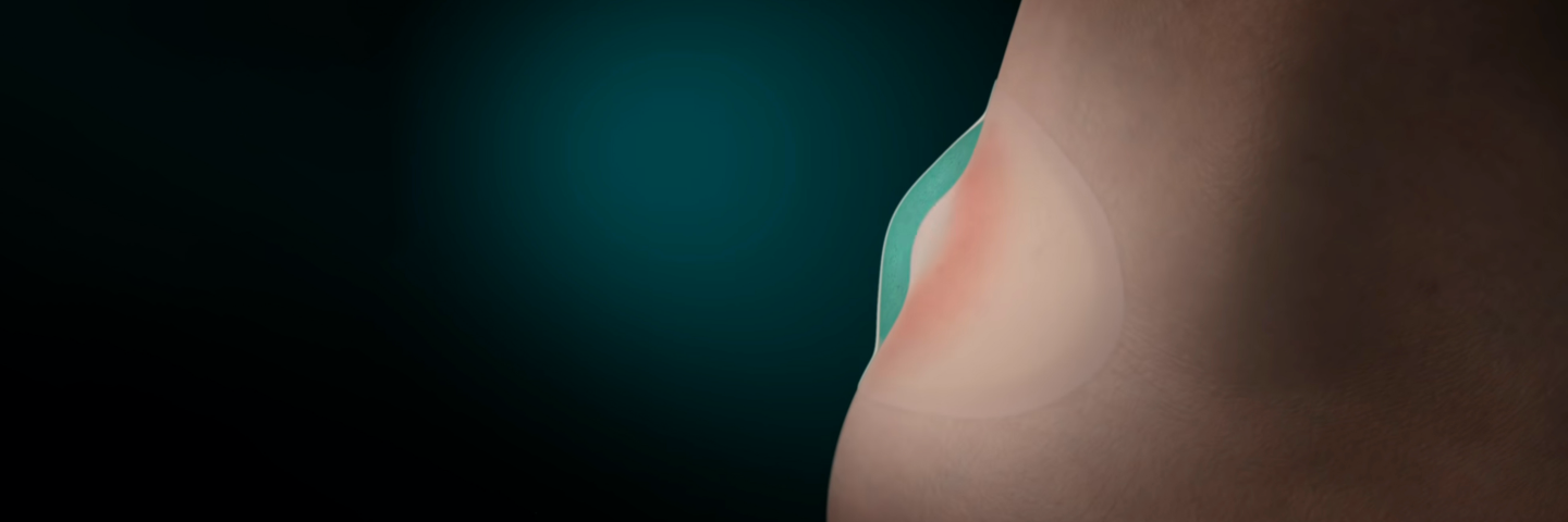 Hydrocolloid Plaster: Mode of Action